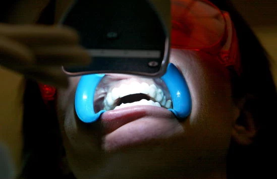 Smilestudio Teeth Whitening Studio, London. Teeth Whitening